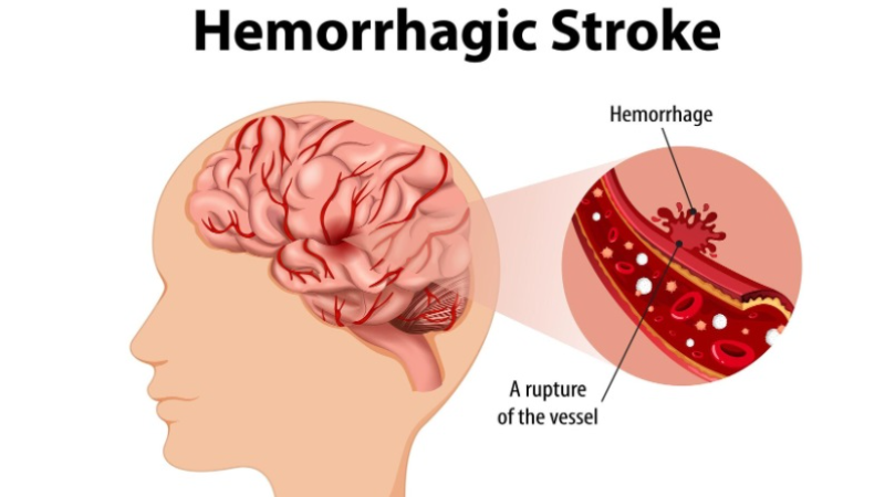 Stroke Hemoragik: Bahaya, Penyebab & Pencegahan